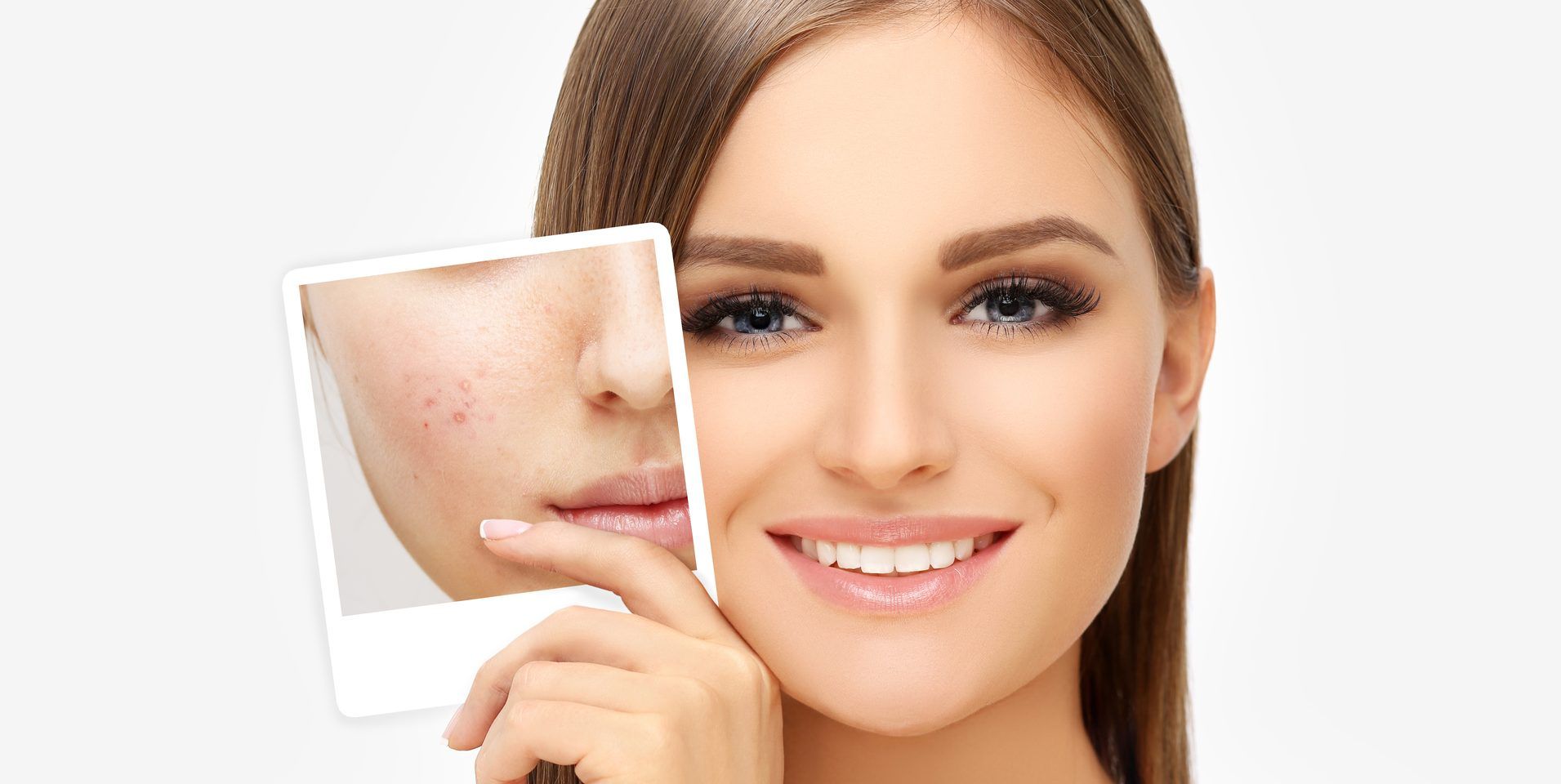 best acne treatment for adults