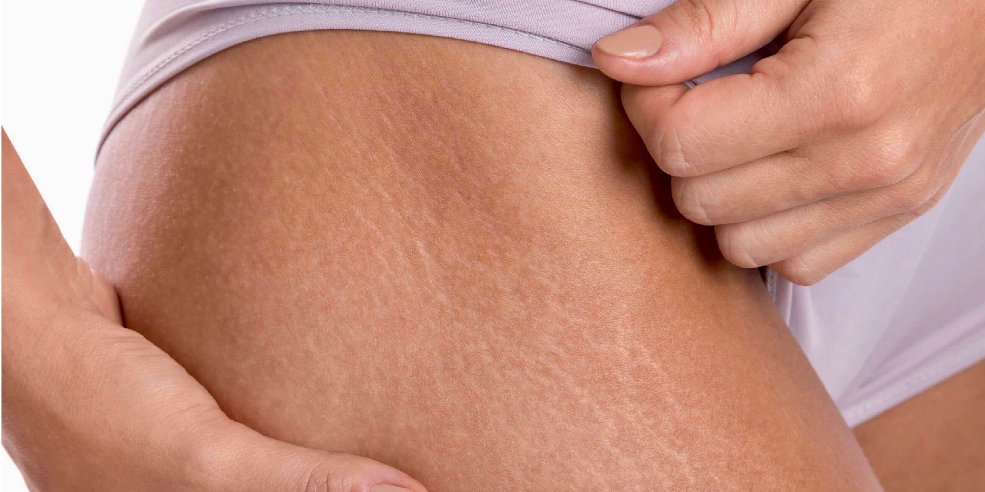 How to Treat Stretch Marks With Collagen | ReviewThis